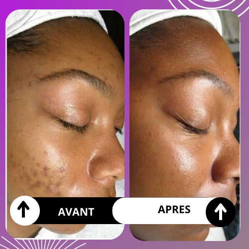 PACK PEAU LISSE: dite adieu aux imperfections sur le visage avec une solution pour une peau plus lisse et éclatante