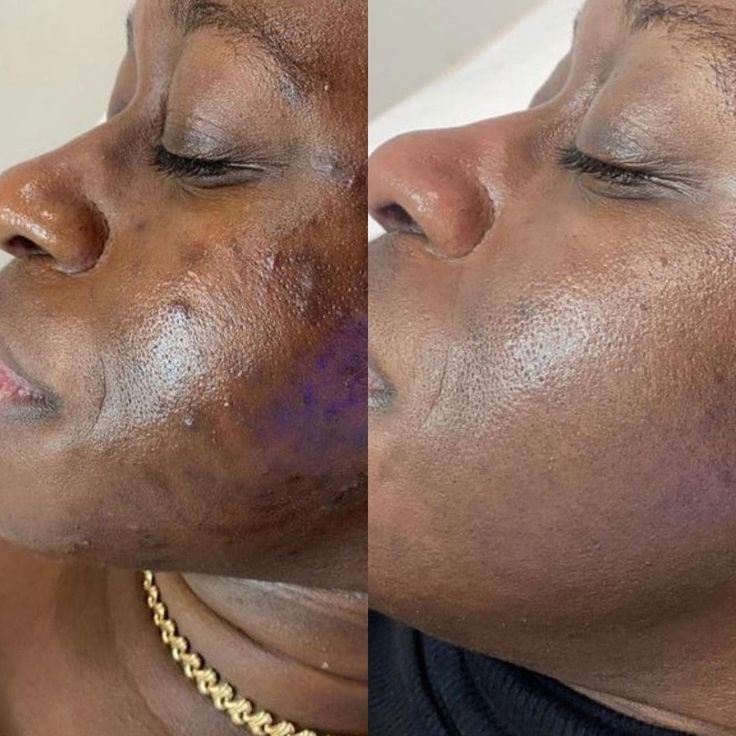 PACK PEAU LISSE: dite adieu aux imperfections sur le visage avec une solution pour une peau plus lisse et éclatante