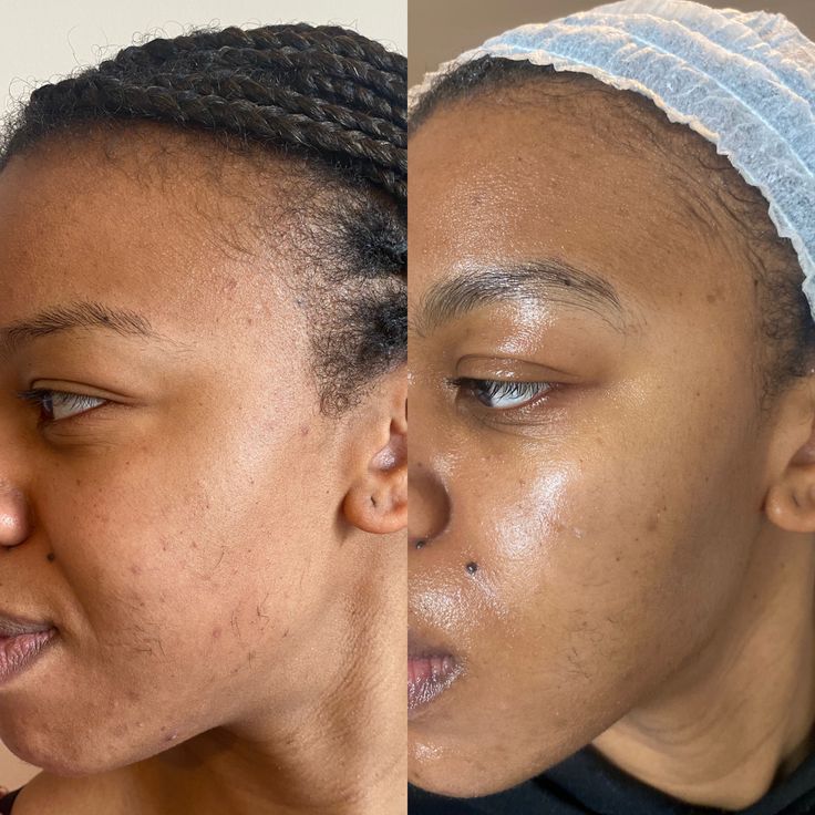 PACK PEAU LISSE: dite adieu aux imperfections sur le visage avec une solution pour une peau plus lisse et éclatante