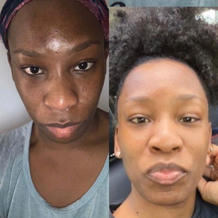 PACK PEAU LISSE: dite adieu aux imperfections sur le visage avec une solution pour une peau plus lisse et éclatante