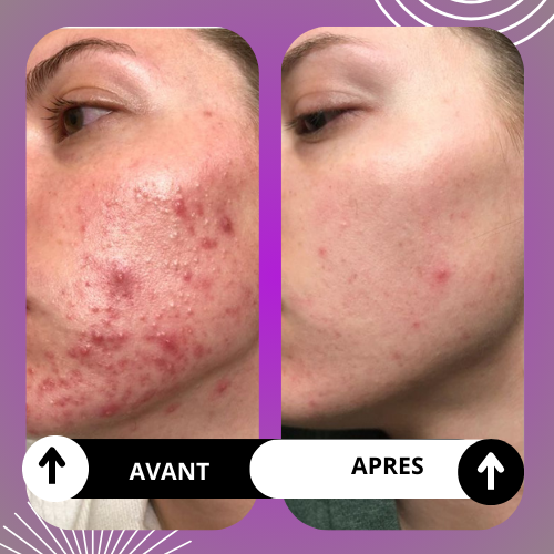 PACK PEAU LISSE: dite adieu aux imperfections sur le visage avec une solution pour une peau plus lisse et éclatante