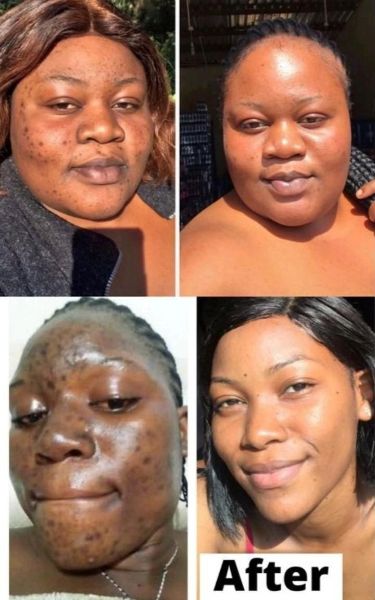 PACK PEAU LISSE: dite adieu aux imperfections sur le visage avec une solution pour une peau plus lisse et éclatante